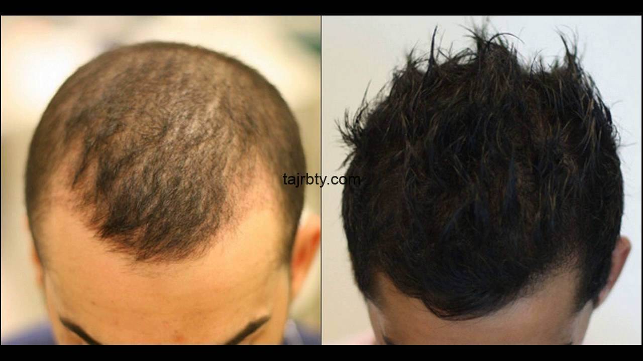 change me clinic حقن البلازما الغنية بالصفائح الدموية prp لتساقط الشعر