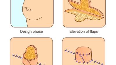 Change Me Clinic زراعة شعر و نحت القوام و تجميل الاسنان عملية استئصال الثدي بالصور